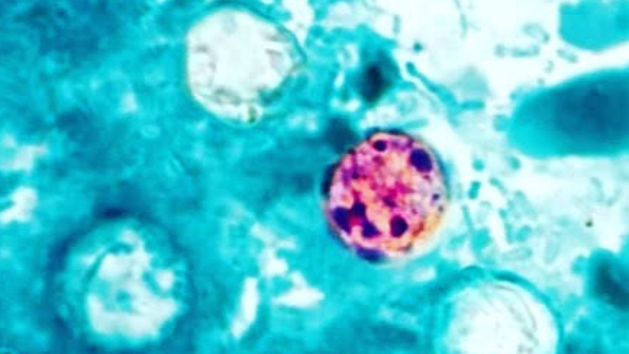 Brote de ciclosporiasis se extiende en EE.UU.; aumentan los casos del parásito asociado a alimentos contaminados
