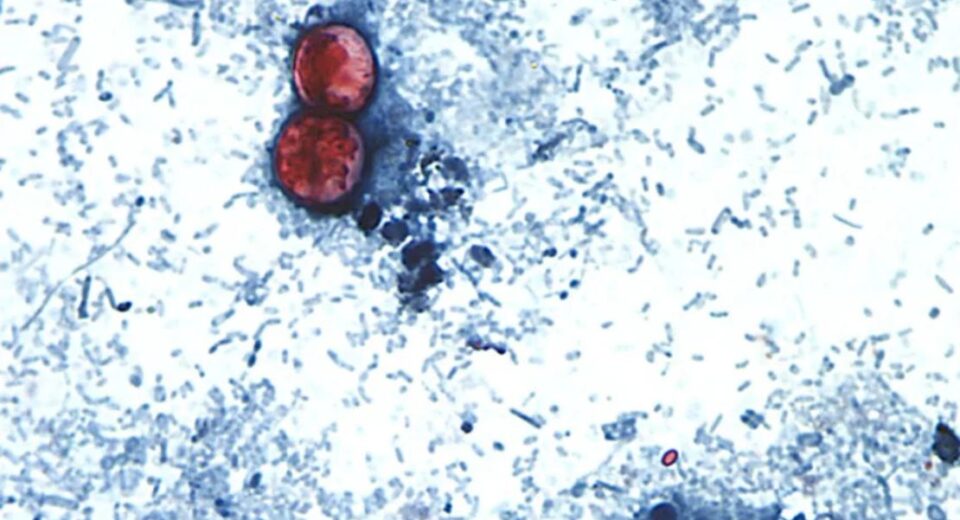 ciclosporiasis