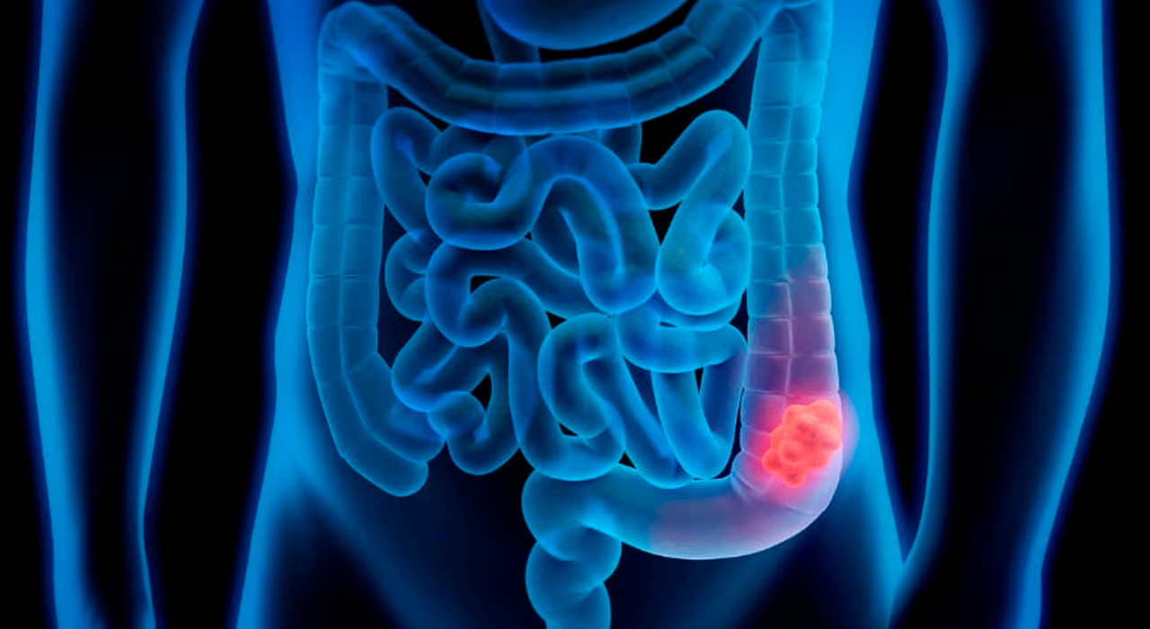 Cáncer de colon