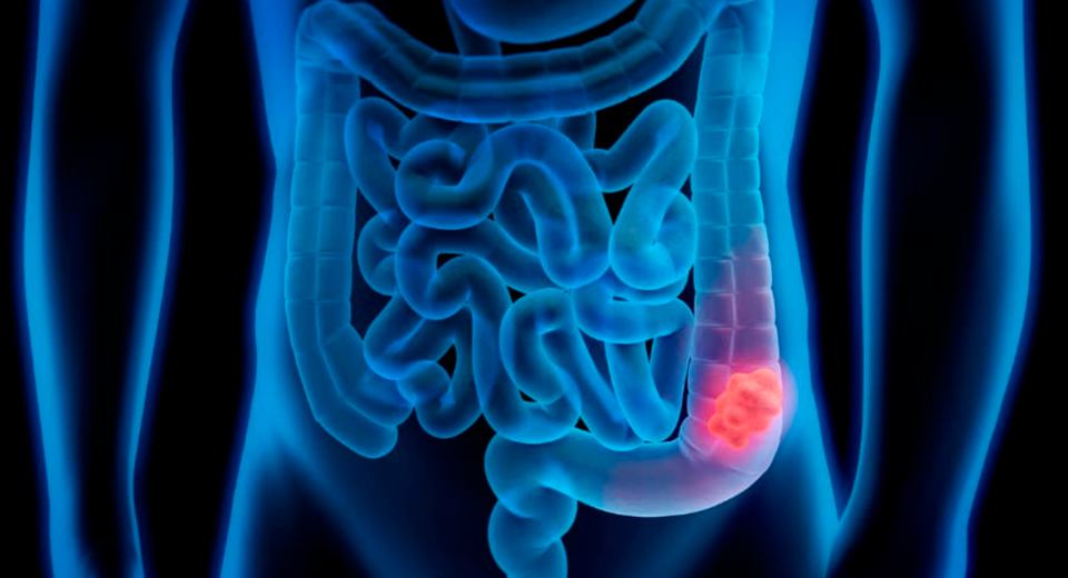 Cáncer de colon