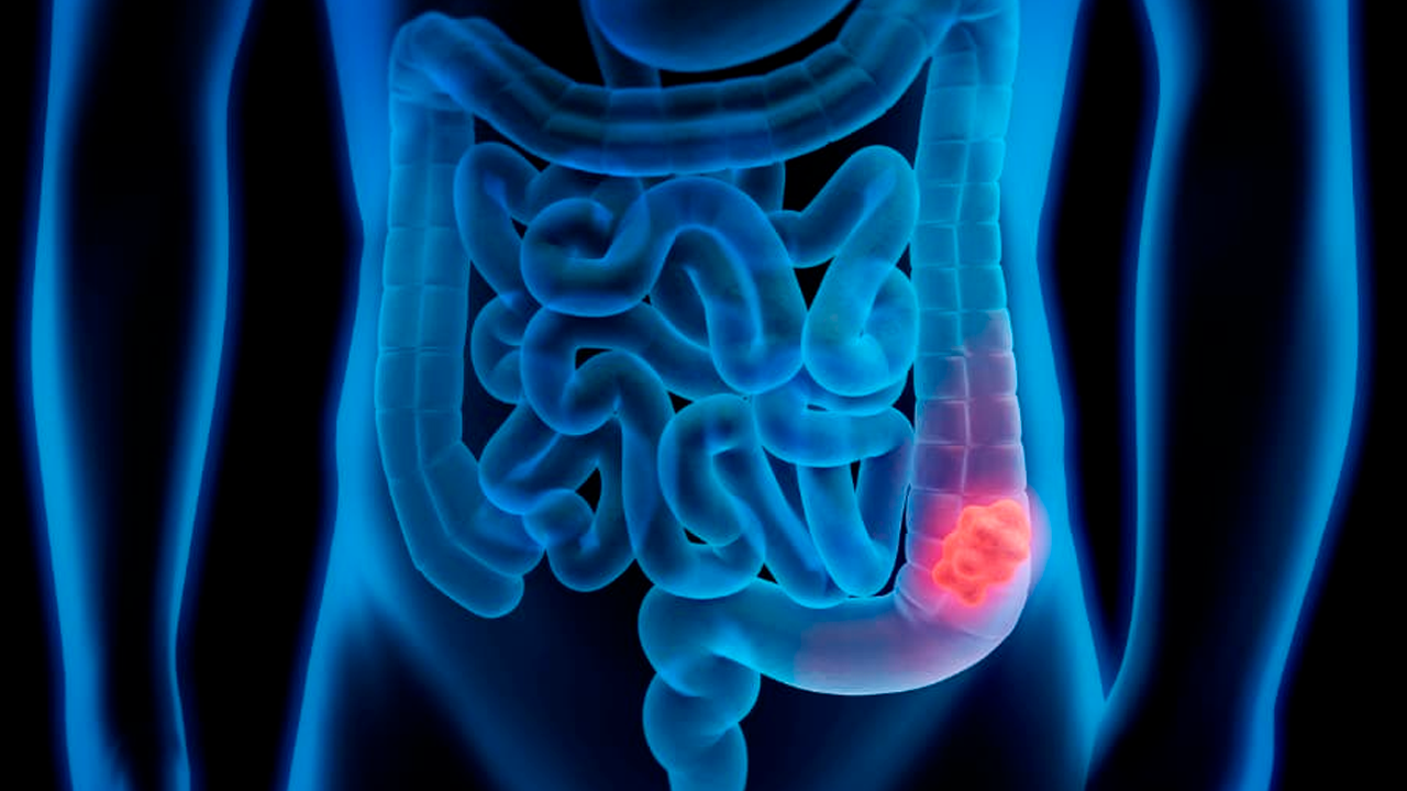 Cáncer de colon