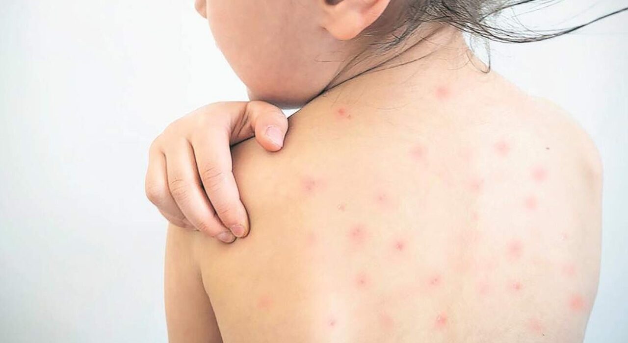 Sarampión alcanza 2,566 casos en Estados Unidos y marca máximo histórico en 35 años