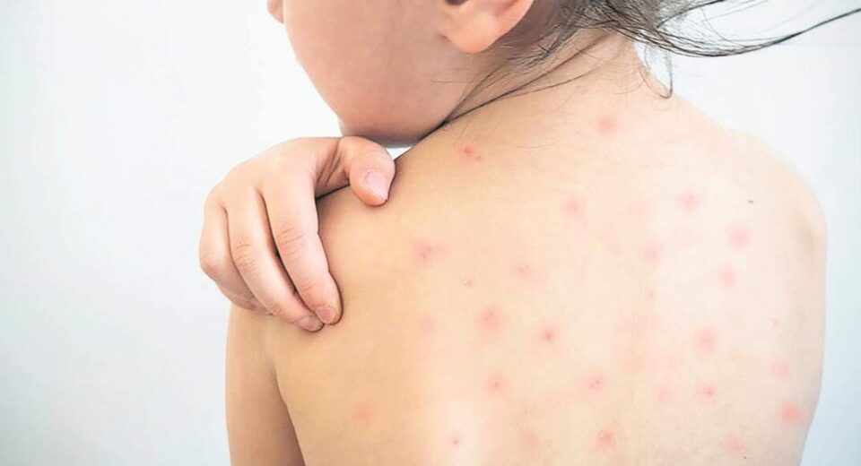 Sarampión alcanza 2,566 casos en Estados Unidos y marca máximo histórico en 35 años