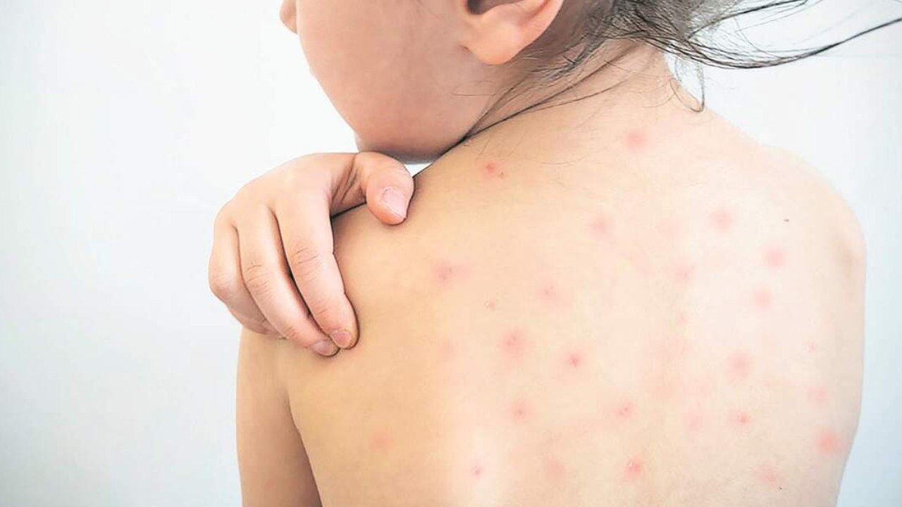 Sarampión alcanza 2,566 casos en Estados Unidos y marca máximo histórico en 35 años
